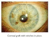 Corneal graft with stitches in place
